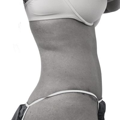 After-thermal-lipolysis-to-the-abdomen-and-flanks-